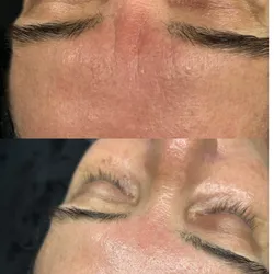Radiofrecuencia facial 