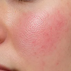 CALMANTE | Piel sensible & Rosacea