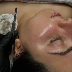 Tratamiento con dermaplaning 