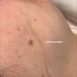 LIMPIEZA PROFUNDA + DERMAPLANING ⭐️