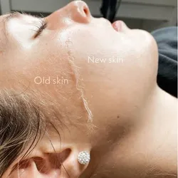 Facial con dermaplanning