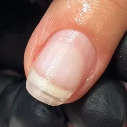 Reparación de hasta tres uñas 