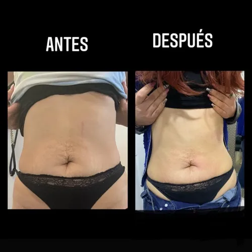 Cavitador más electrodos