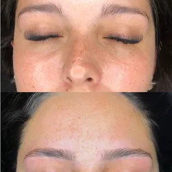 Tratamiento y restauración de cejas 