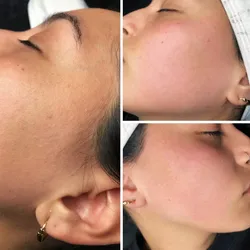 Depilación de rostro completo con hilo 