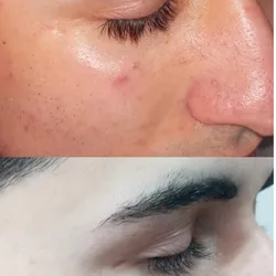 DESPIGMENTACIÓN FACIAL