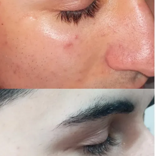 DESPIGMENTACIÓN FACIAL