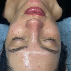 Limpieza Facial Profunda + Dermaplaning 