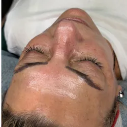 Limpieza Facial Profunda + Microneedling 