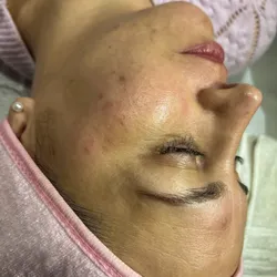 • Dermaplaning + Peeling químico •