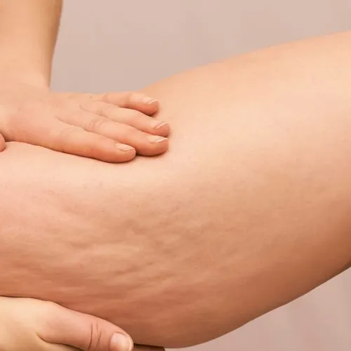 Body Celulitis