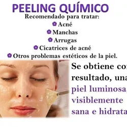 Peeling quimico