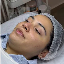 Limpieza Facial Profunda+Dermapen+Exosomas
