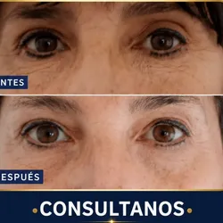 LIFTING FACIAL - HIFU ROSTRO