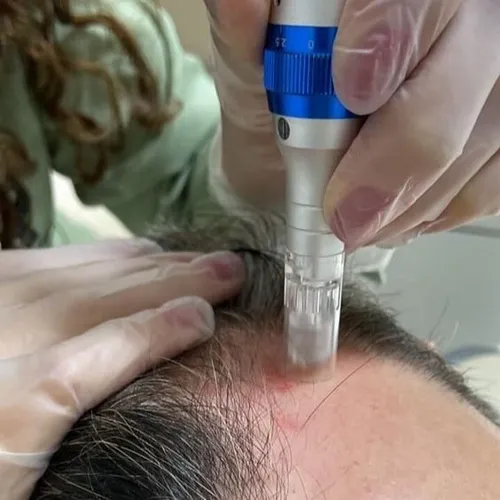 MICRONEEDLING CAPILAR / THERAPY CAPILAR, de ZENIA ATELIER