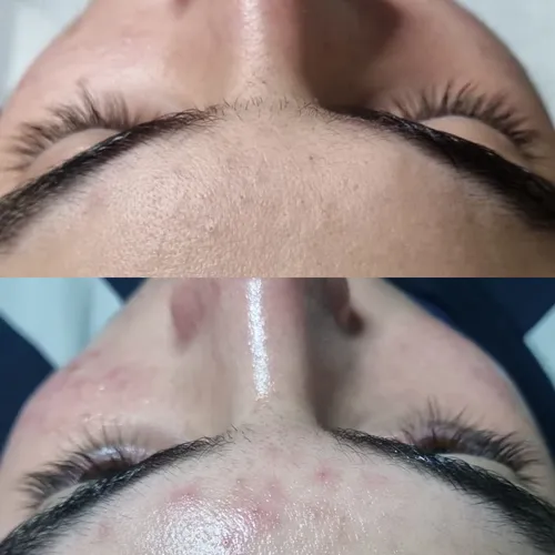 Acné & Rosácea, de Glow Lab
