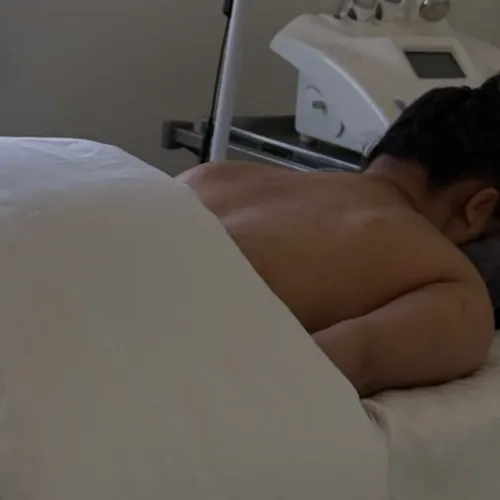 Peeling químico en espalda, de Softskin