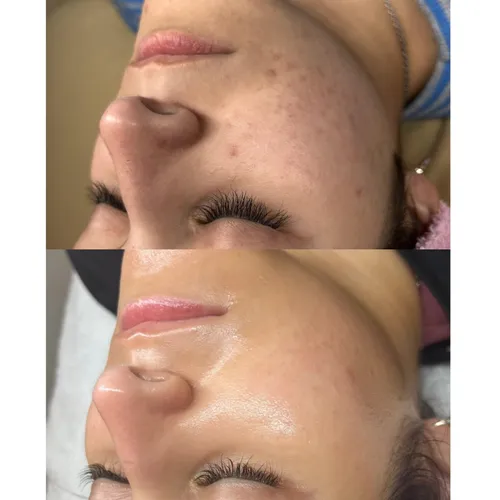 ⭐ FULL FACE: EL TRATAMIENTO FACIAL MÁS COMPLETO, de CLEO ESTÉTICA INTEGRAL