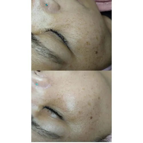 Microneedling, de Bren.Nailstudy 