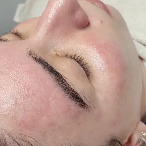 Dermaplaning 