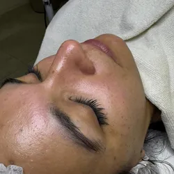 Limpieza facial con peeling ( extracciones solo en nariz ) 