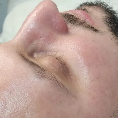 Limpieza facial profunda ( extracciónes rostro completo)