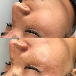 Combo dermaplaning+lash lifting