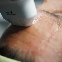 Hifu rostro papada y cuello