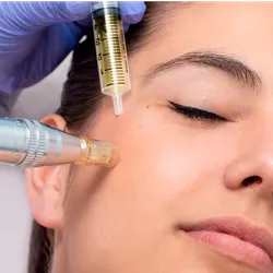 MICRONEEDLING 