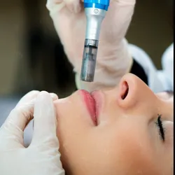 Microneedeling