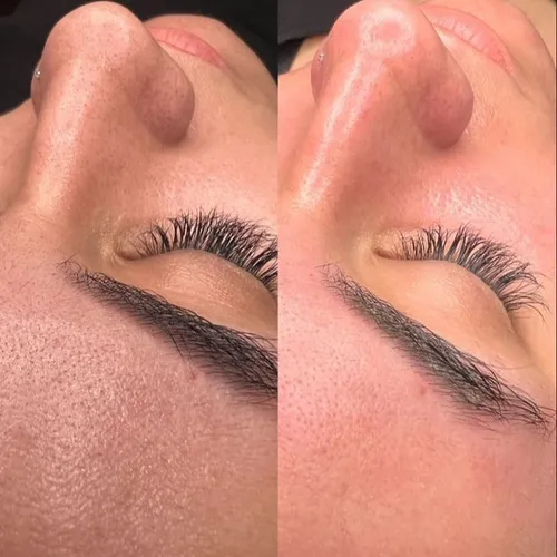 Peeling químico