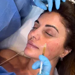 PRP Facial (sesión única)