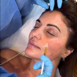 PRP Facial (5 sesiones)