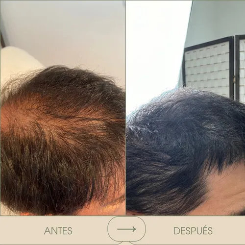 PRP Capilar (sesión única)