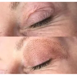 PLASMAPEN FIBROBLAST  párpados)