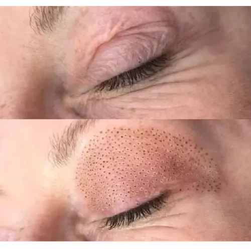 PLASMAPEN FIBROBLAST  párpados)