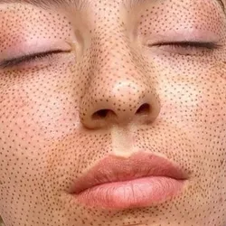 PLASMAPEN FIBROBLAST (full face)