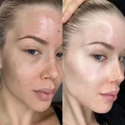 Dermaplaning + Dermapen (Microneedling)+ hilos de colágeno 
