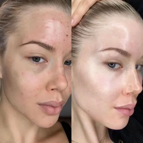 Dermaplaning + Dermapen (Microneedling)+ hilos de colágeno 