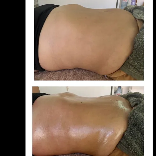Maderoterapia corporal + drenaje linfático 
