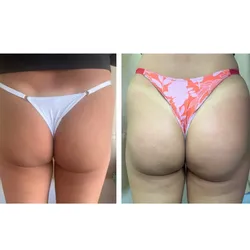 Tratamiento peptonas (gluteos UP) 