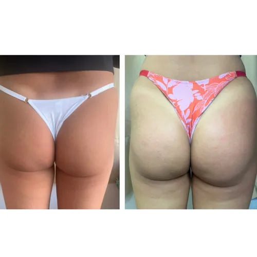 Tratamiento peptonas (gluteos UP) 