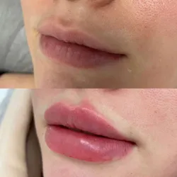 RELLENO LABIAL AC. HIALURONICO 