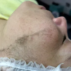 Limpieza con dermaplaning 