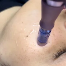 Limpieza facial con microneedling 