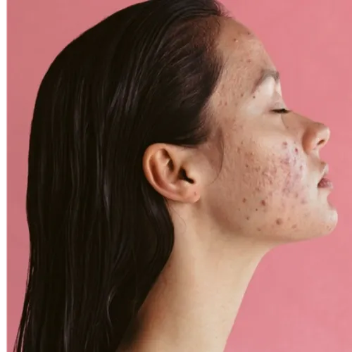 Antiacne