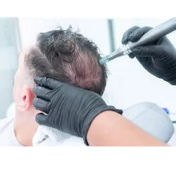 Minoxidil (Capilar)