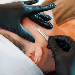 DERMAPLANING
