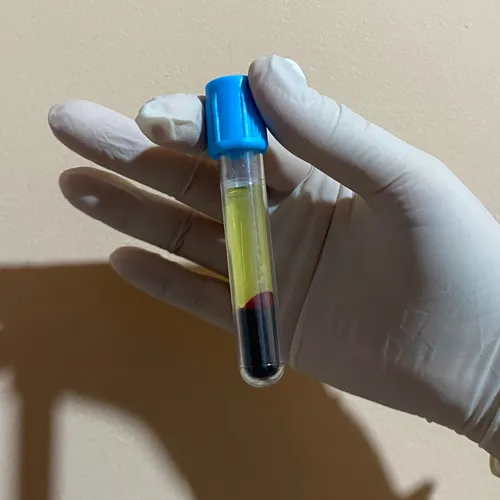 Plasma Rico en Plaquetas
