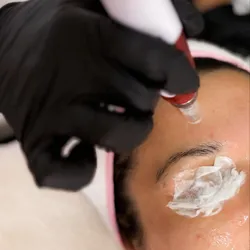 Dermapen/microneedling (EFT $42.000)